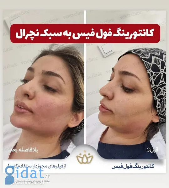 نمونه زاویه سازی صورت دکتر آریا شفیعی